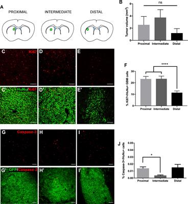 Glioblastoma Proximity to the Lateral Ventricle Alters Neurogenic Cell Populations of the Subventricular Zone